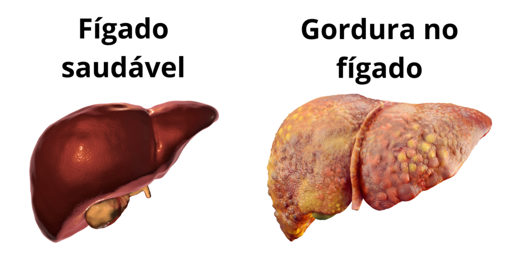 Comparativo: Fígado Saudável vs Gordura no Fígado